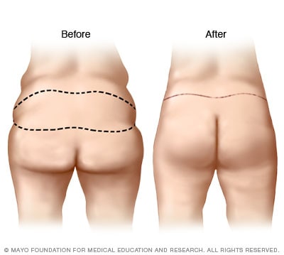 Illustration of buttock lift results 
