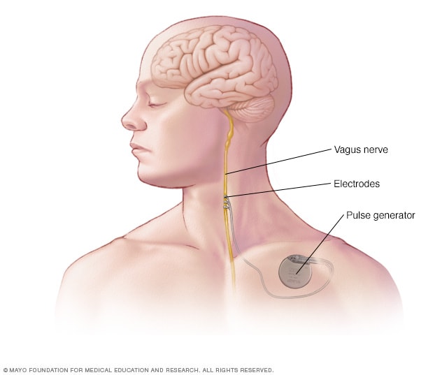 An implanted vagus nerve stimulation